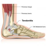 Tendonitis Signs, Diagnosis and Treatments