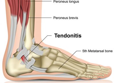 Tendonitis Signs, Diagnosis and Treatments